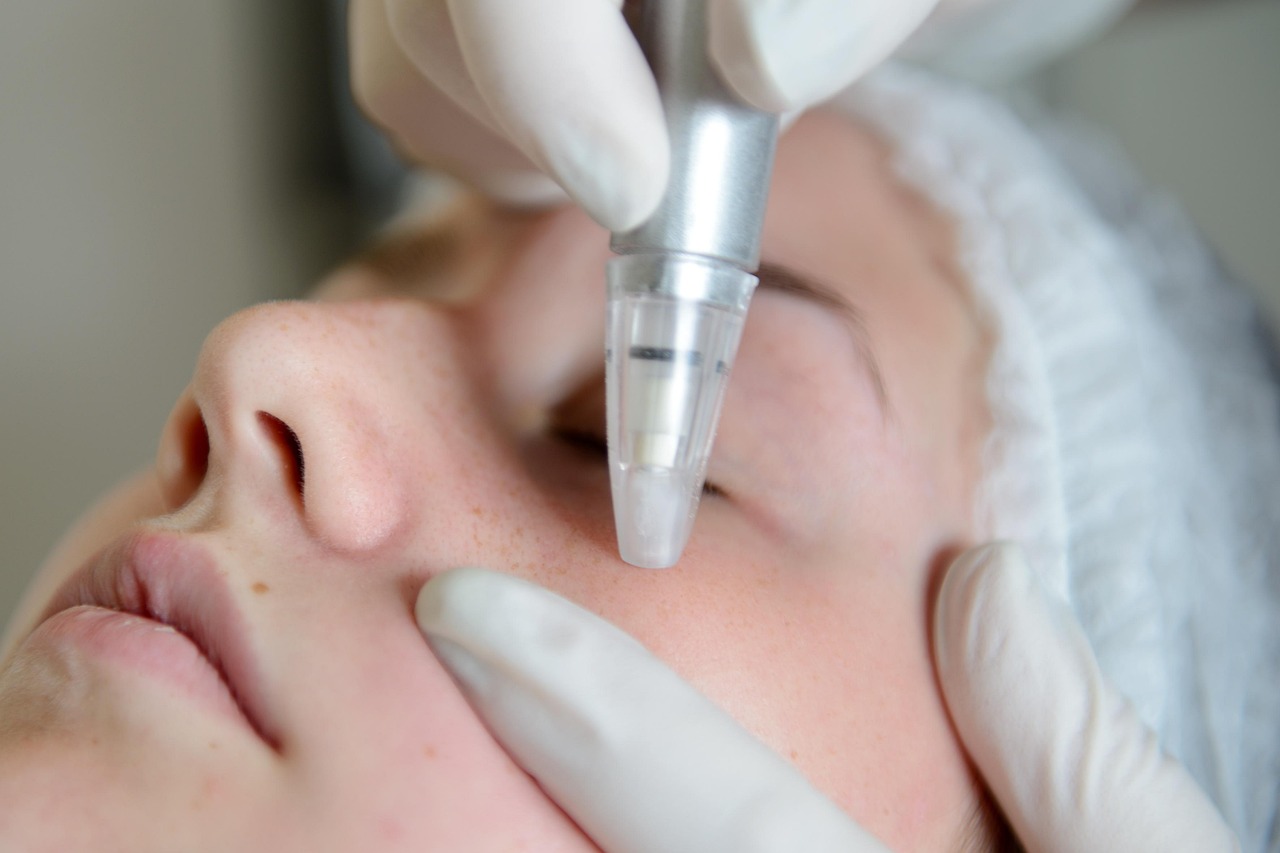 Woman, microdermabrasion, skin improvement — The Ultimate Guide to Mail Order Marijuana: What You Need to Know